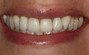 After Veneers